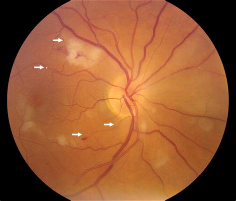 Multiple Retinal Emboli In A Case Of Acute Stroke Practical Neurology