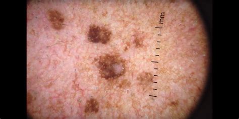 Melanoma Skin Cancer Lesions
