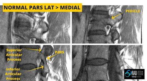 Pars Defects How To Find Them Easily On Mri Radedasia