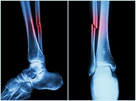 10 Facts You Must Know About Bone Fractures