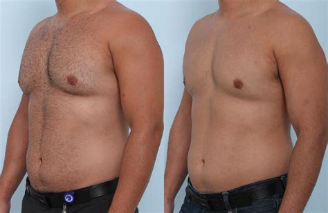 Cool Sculpting Before And After Pictures