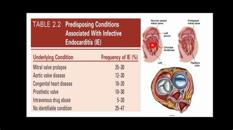 Infective Endocarditis Youtube
