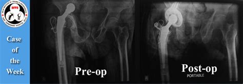 Total Hip Replacement Sant Parmanand Hospital