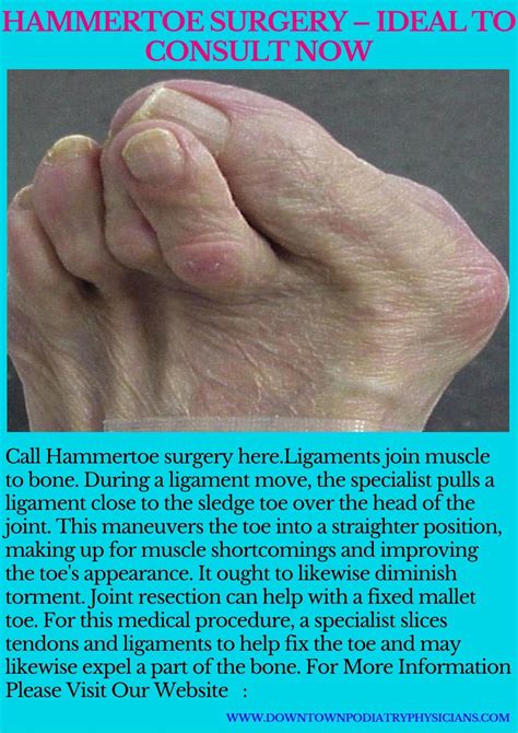 Hammertoe Surgery Ideal To Consult Now In 2020 Hammer Toe Surgery