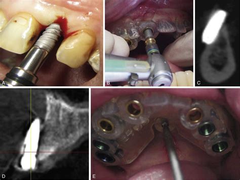 Dental Implant Intraoperative Complications Pocket Dentistry