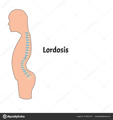 Posici N De La Columna Vertebral Con Lordosis Curvatura Espinal Cifosis Lordosis Escoliosis