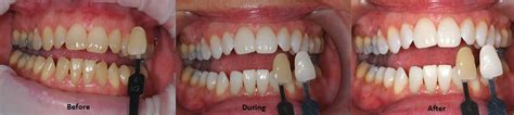 Thinking Of Whitening Your Teeth What Are The Options Mckeefry Dental