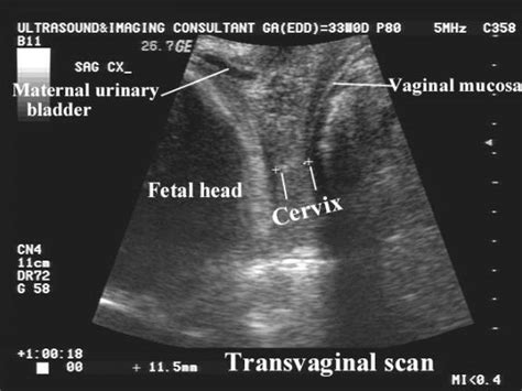 35 Week Pregnancy Ultrasound Pregnancywalls