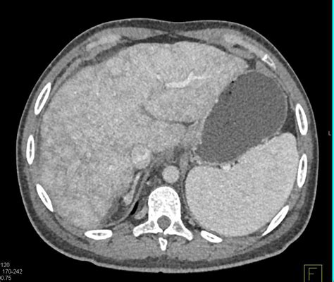 Cirrhosis Of The Liver With Hepatic Congestion Liver Case Studies