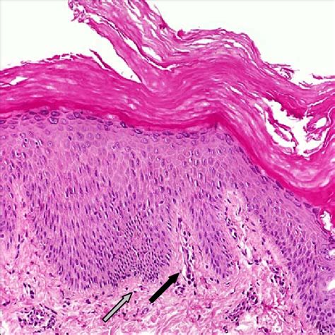 Histology Of Atopic Dermatitis Staining Of An Atopic Dermatitis Tissue