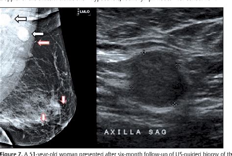 Figure 7 From Abnormal Axillary Lymph Nodes On Negative Mammograms