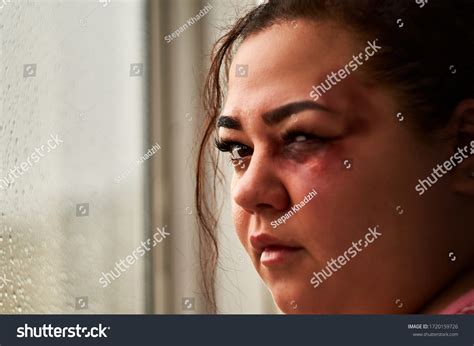 Woman Bruise On Face Sadly Looking Stock Photo 1720159726 Shutterstock