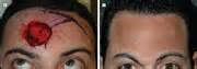 Jama Network Jama Facial Plastic Surgery Double Opposing Rotation