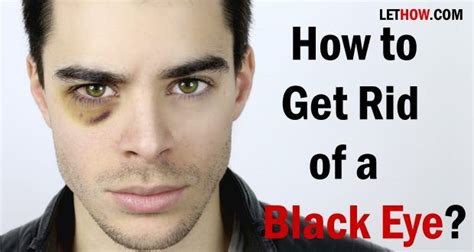 Home Remedies To Get Rid Of Black Eye Black Eye Remedies Eye Black