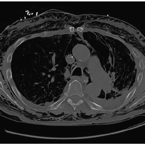 Ct Chest Showing Extensive Subcutaneous Emphysema Download