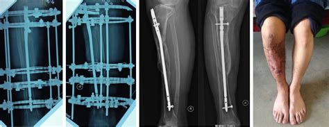 Outcomes Of Post Traumatic Tibial Osteomyelitis Treated With An