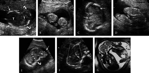 Craniopagus Twins At 12 Weeks Resolution Limited By Fetal Age A