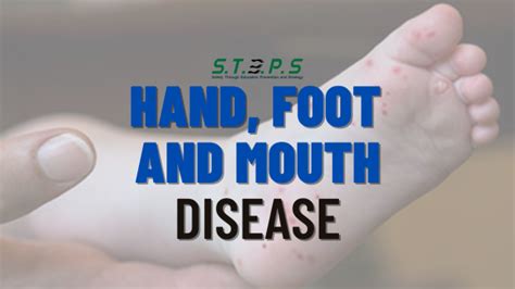 Hand Foot And Mouth Disease Safety Steps