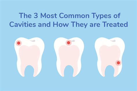 The 3 Most Common Types Of Cavities And How They Are Treated Smilekeepers