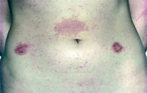 Medical Pictures Info Allergic Skin Reaction