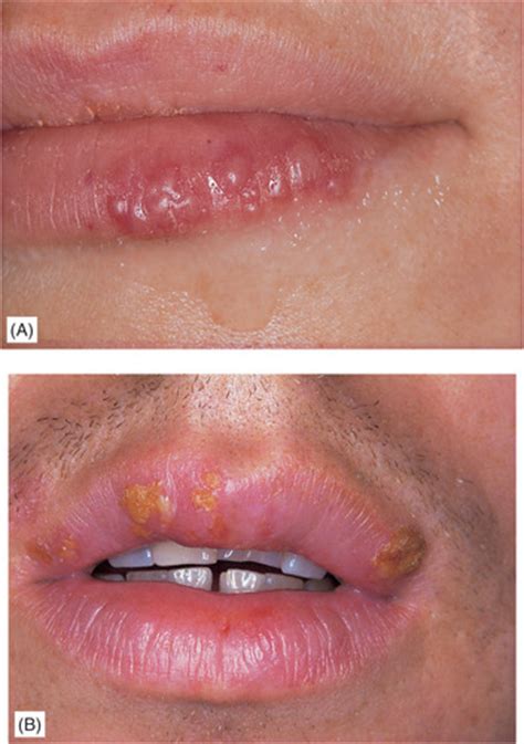 12 Diseases Of The Oral Mucosa Introduction And Mucosal Infections