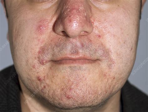 Acne Pimples And Scars Stock Image C0142524 Science
