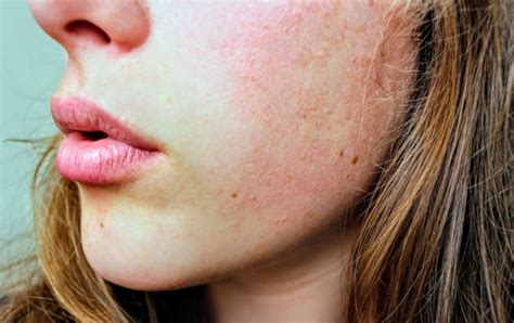 Is Eczema Contagious Everything You Need To Know