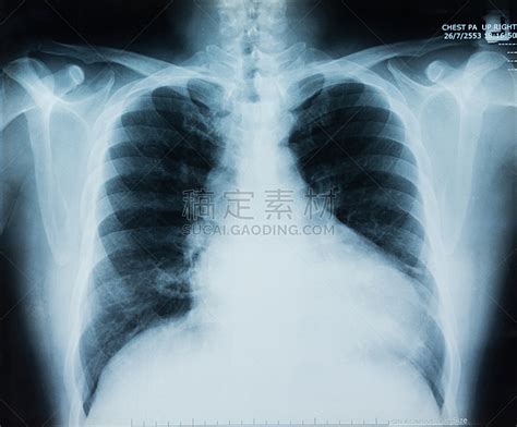 胸部 x光片 人类肺脏 视角 姿态优美 肺部感染 锁骨 结核杆菌 肩胛骨 胸腔图片素材下载 稿定素材