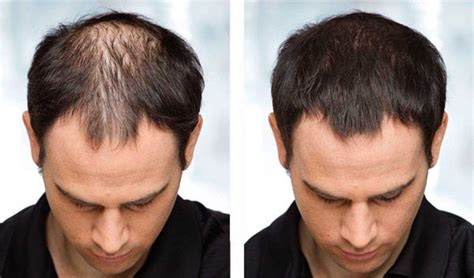 Hair Loss Treatments Canada Hair Loss