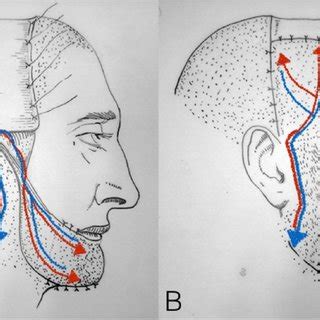 A Drawing Of The Bipedicled Scalp Flap Procedure After Positioning In