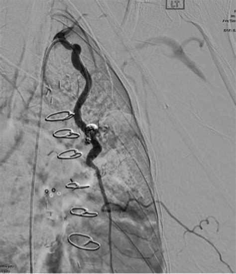 Iatrogenic Internal Mammary Arteriovenous Fistula Journal Of Vascular