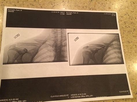 Broken Clavicle Surgery Plate And Screws What Would You Do
