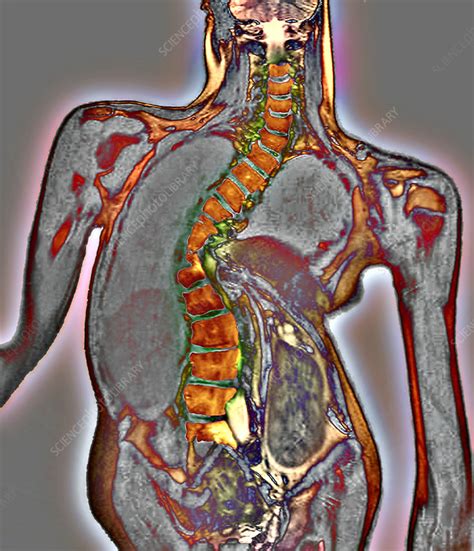 Curvature Of The Spine Mri Scan Stock Image M1900108 Science