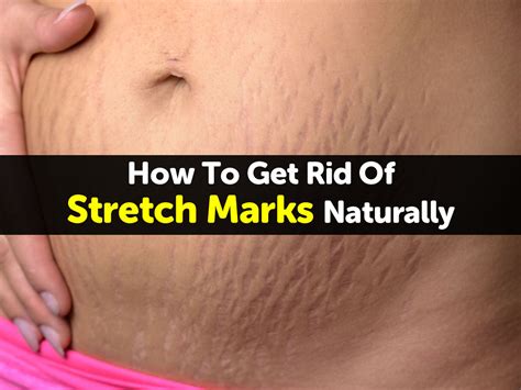 How To Get Rid Of Stretch Marks Naturally