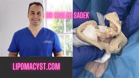 Massive Abdominal Cyst Dr Khaled Sadek LipomaCyst Com YouTube