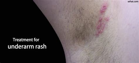 Natural Remedies To Treat Armpit Rash Quickly Sehat