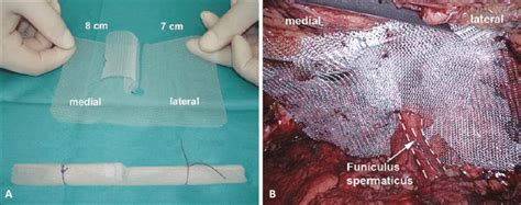 Creation And Placement Of The Prolene Mesh For A Right Sided Inguinal