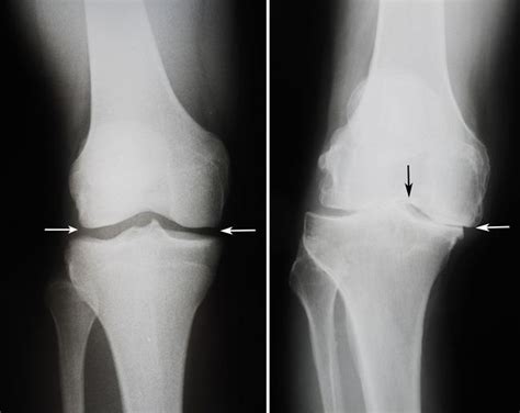 Total Knee Replacement Orthoinfo Aaos