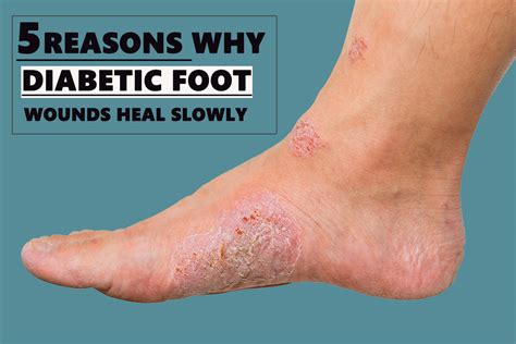 5 Reasons Why Diabetic Foot Wounds Heal Slowly Dr Chetan Oswal