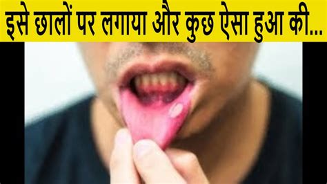 Muh Ke Chalo Ka Ilaj Munh Ke Chhale Mouth Ulcer Home Remedy Muh Ke