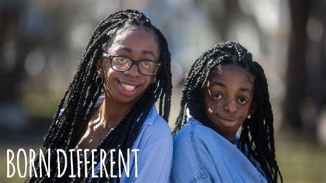 Inspirational Sisters Share Rare Facial Disorder Born Different