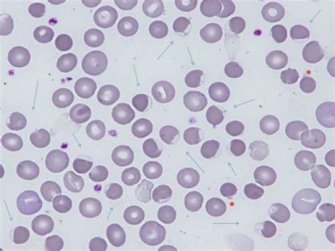 Blister Cells Hemighosts And Bite Cells Degmacytes In A Patient
