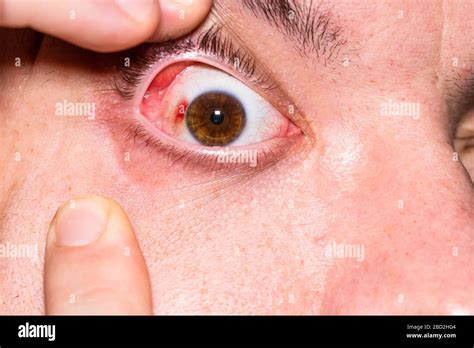 Eye Injury Young Man With Burst Blood Vessel In Eye Fatigue Problems