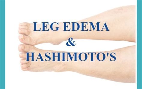 Hashimotos Leg Swelling