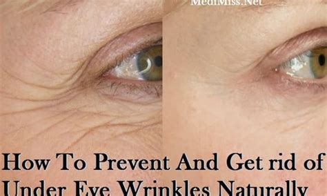 How To Get Rid Of Under Eye Wrinkles Naturally Fashion Daily