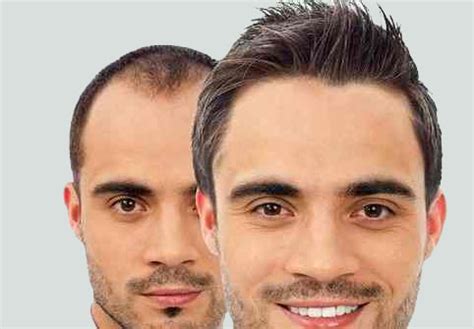 Instructions To Choose The Useful And Best Hair Transplant Clinic How
