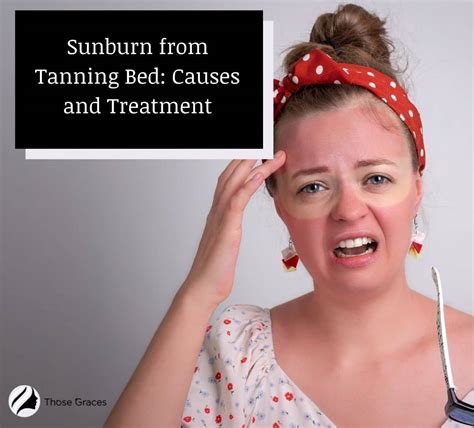 Sunburn From Tanning Bed Causes Prevention And Treatment