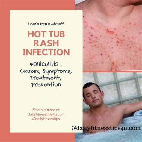 how to get rid of hot tub rash bacteria hot tub rash cure medical home remedies hot tub rash