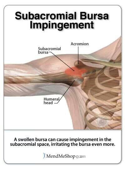 Subacromial Bursa Impingement Shoulder Impingement Surgery Shoulder Tendonitis Shoulder