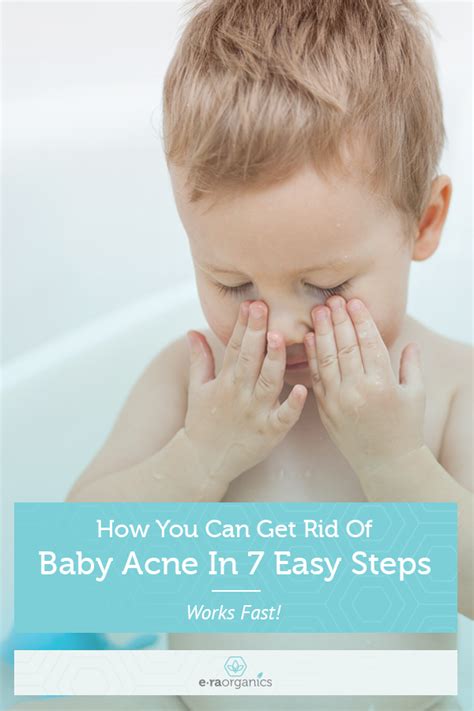 How To Get Rid Of Baby Acne In 7 Easy Steps Baby Acne Organic Baby